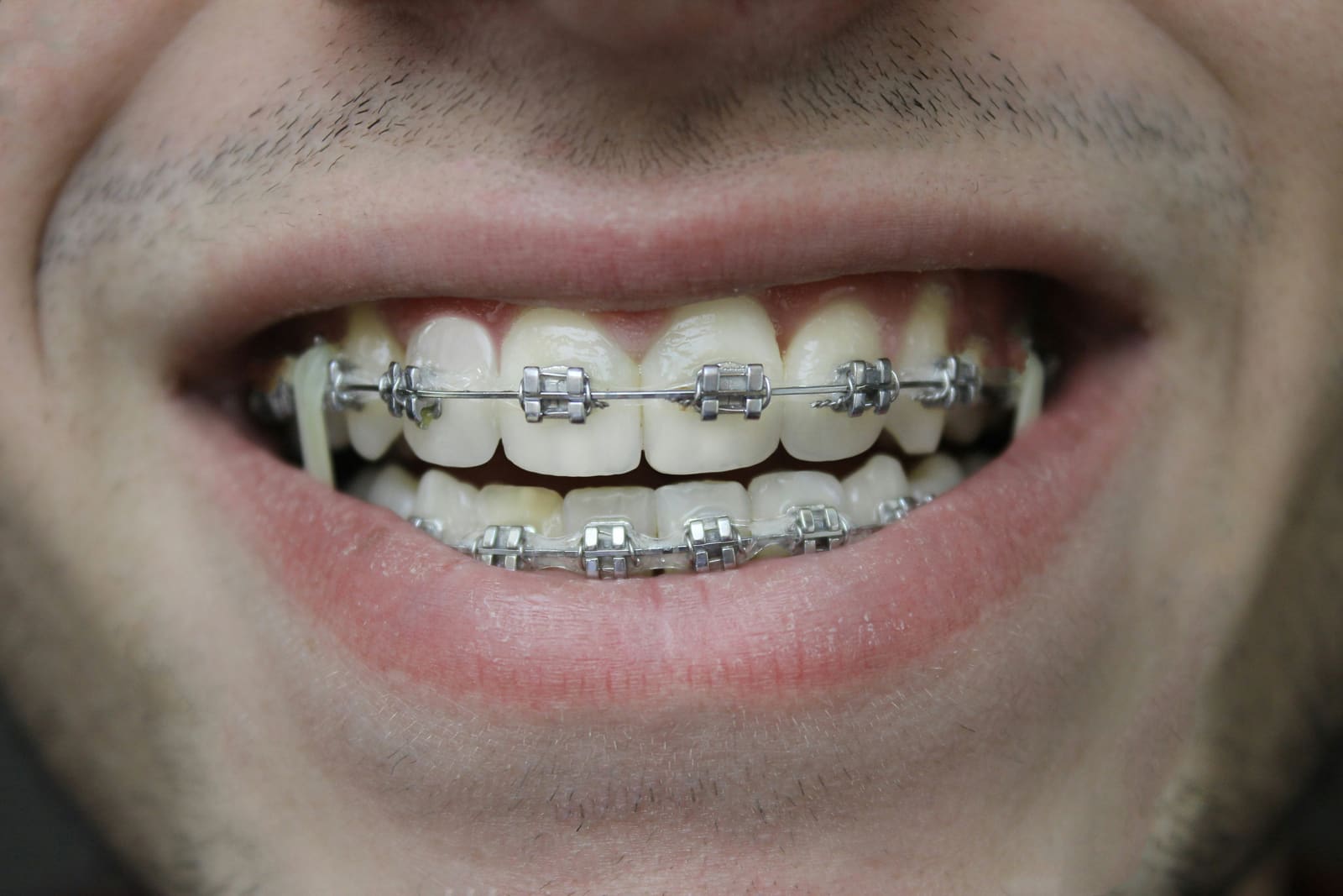 Sorriso com aparelho ortodôntico fixo metálico nos dentes superiores e inferiores