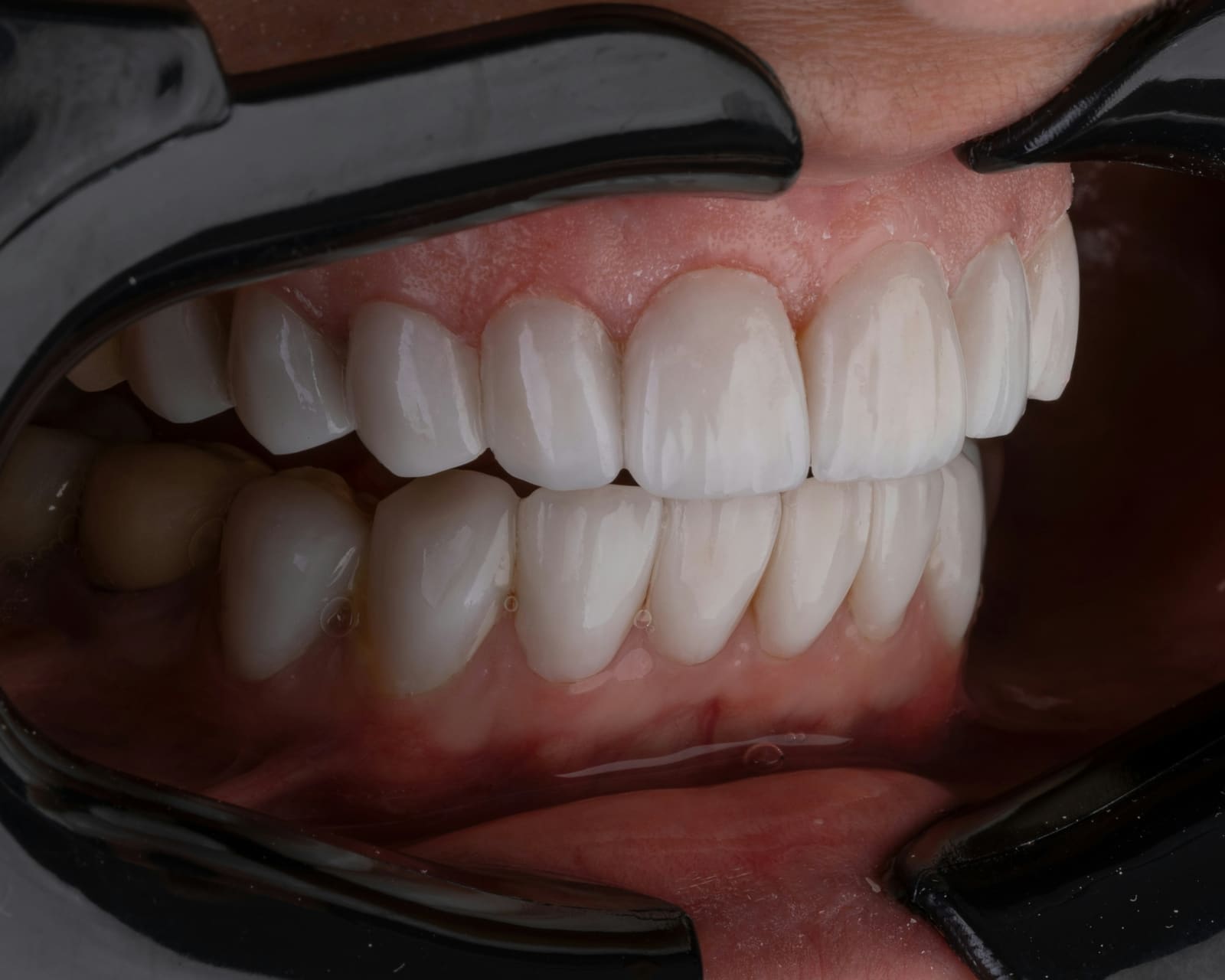 Sorriso com facetas de porcelana de aparência natural